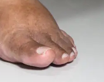 Prise en charge sécurisée et spécifique du pied diabétique : coupe d’ongles sans risque, élimination des
hyperkératoses, conseils de prévention et hydratation profonde.
