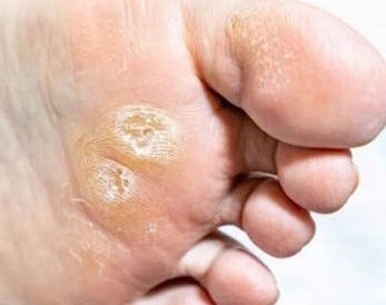 Élimination mécanique des zones de pression douloureuses (cors, durillons, callosités) suivie d’une
hydratation réparatrice.