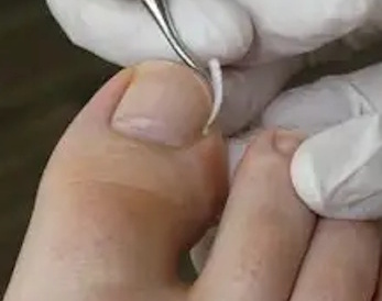 Prise en charge spécialisée des ongles incarnés : soulagement immédiat, désinfection, coupe corrective et
conseils de prévention.