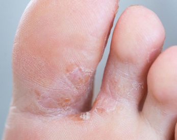 traitement antifongique avec fraisage médical doux et application de produits thérapeutiques spécifiques et
pensement occlusif tous les 48 h.