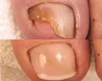 Reconstruction partielle ou totale d’un ongle abimé ou traumatisé, avec résine ou gel médical adapté.
15 € (1 ONGLE), 25 € (2 ONGLES)