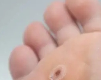 Traitement tous les 48 h localisé des verrues.